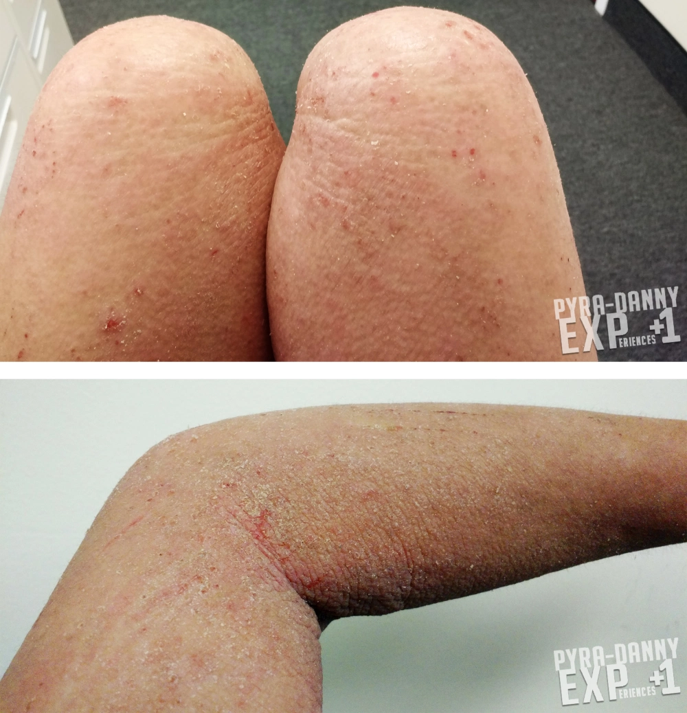 2 weeks into CellCept. [Top] These hot dog knees look kinda burnt. [Bottom] Oh my poor poor arm