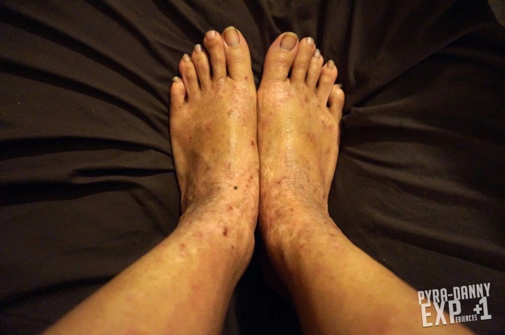 My feet are very dry but I don't want to wear socks all the time to cover up. [Current Status of Severe Eczema: PyraDannyExperiences.com]