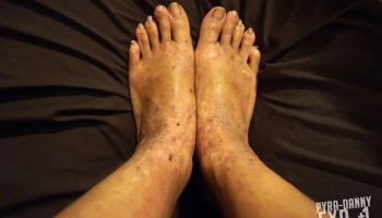 My feet are very dry but I don't want to wear socks all the time to cover up. [Current Status of Severe Eczema: PyraDannyExperiences.com]