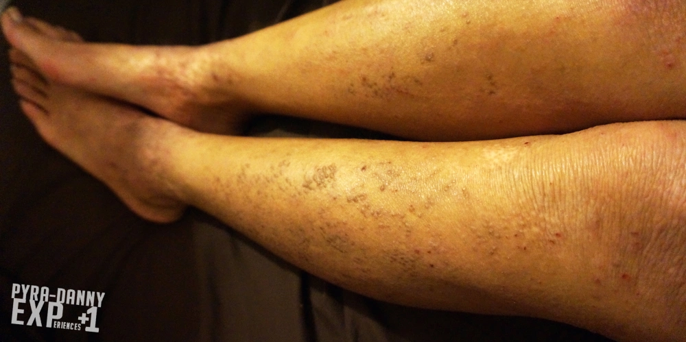 Tiny, flat, hard, and gray clusters on my shins [Current Status of Severe Eczema: PyraDannyExperiences.com]