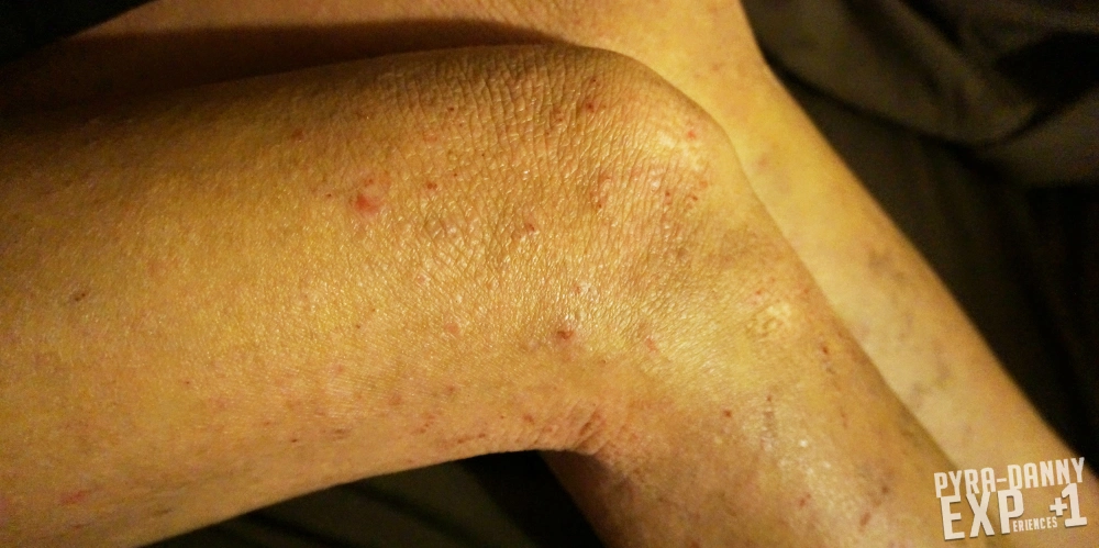 The sides of my knees (and around them) stubbornly stays dry and itchy [Current Status of Severe Eczema: PyraDannyExperiences.com]