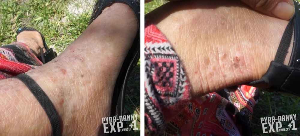 Ankle wounds drying up [EczeMAD 04 Video Status of my Skin | PyraDannyExperiences.com]