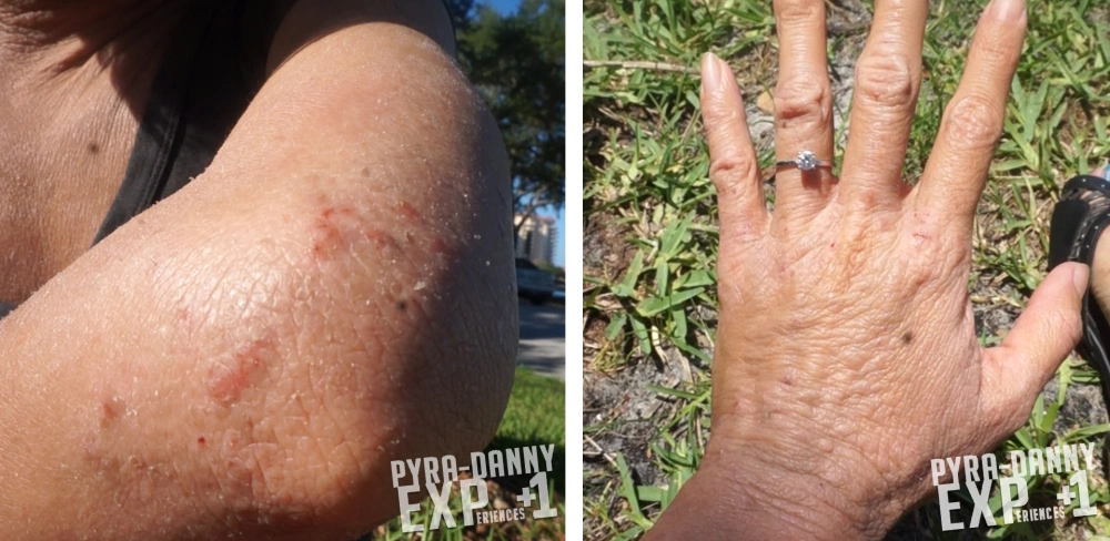 Elbows and hands improving [EczeMAD 04 Video Status of my Skin | PyraDannyExperiences.com]